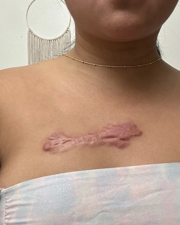 June 2023 puffy keloid scar on chest from injection and laser