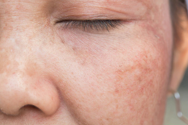 skin hyperpigmentation causes uneven skin color