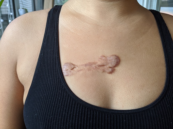 1st injection 3 inch chest keloid 4-13-2020