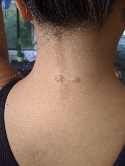 1st injection keloids scars on nape of neck from surface piercing 4-13-2020