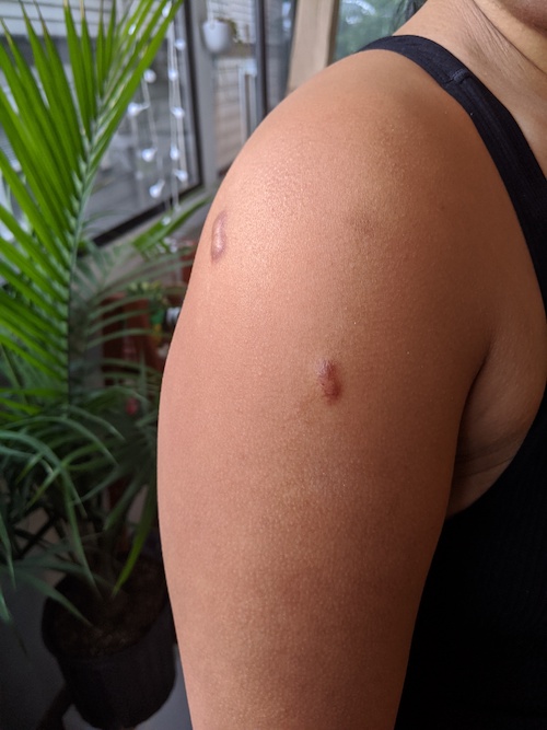 1st injection shoulder keloid scars 4-13-2020