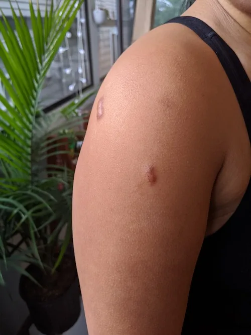 1st injection shoulder keloid scars 4-13-2020