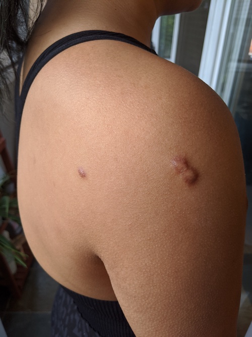 1st injection shoulder keloid scars back 4-13-2020