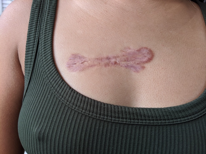 Chest Keloid Scar 5th Injection October 2020