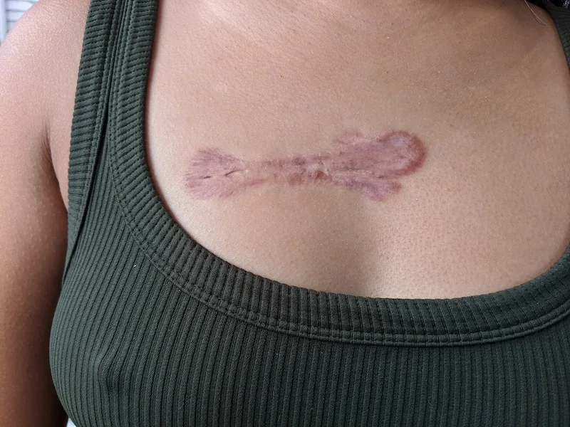 Chest Keloid Scar 5th Injection October 2020