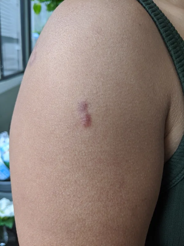 Front Shoulder Keloid Scar 5th Injection October 2020