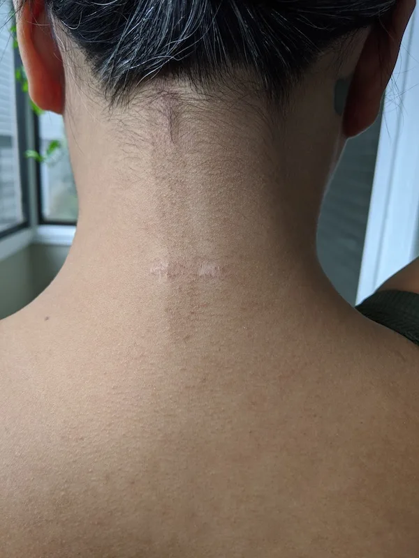 Neck Keloid Scar update October 2020