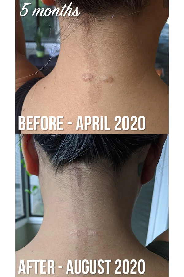 before and after keloid scar steroid injections