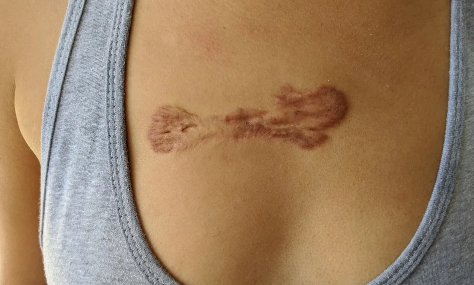 chest keloid after third injection schimiggy