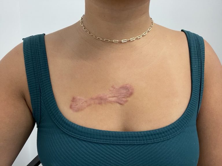 My Keloid Treatment Journey Using Kenalog Schimiggy Reviews