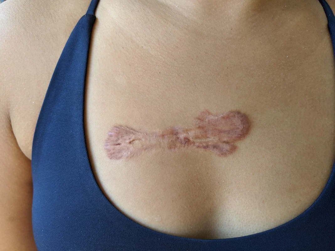 keloid scar steroid treatment 4th injection chest scar