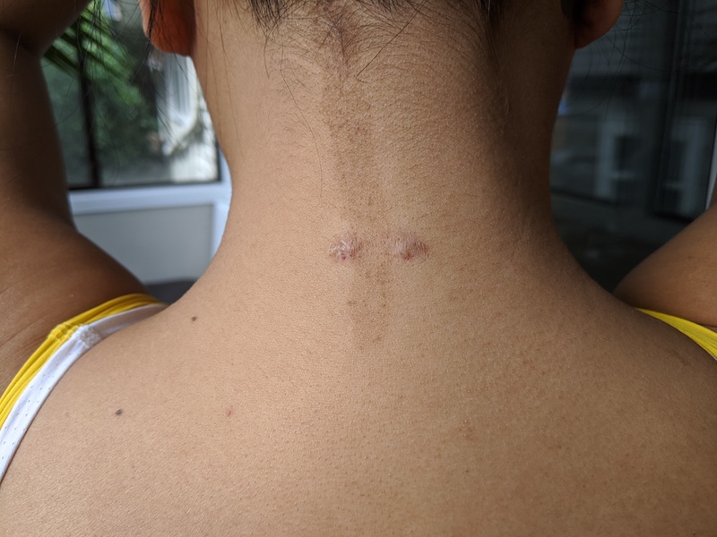 keloid scar steroid treatment nape of neck 2nd injection