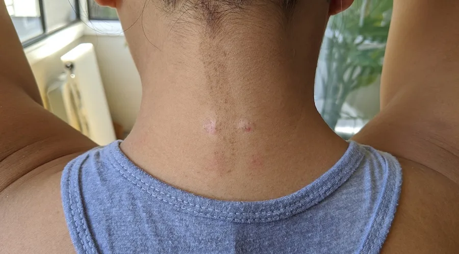neck keloid scars after third steroid injection