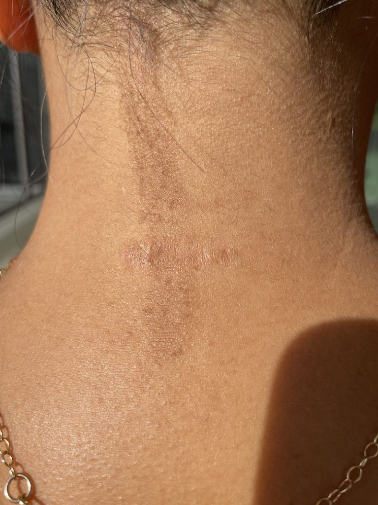 My Keloid Treatment Journey Using Kenalog Schimiggy Reviews