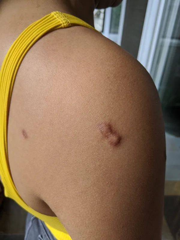 shoulder keloid scar front side 2nd treatment of steroid injection treatment