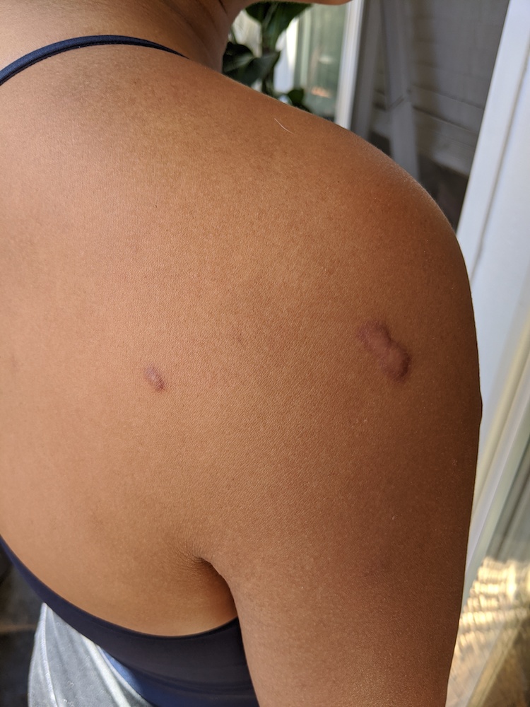 keloid scar steroid treatment 4th injection back shoulder