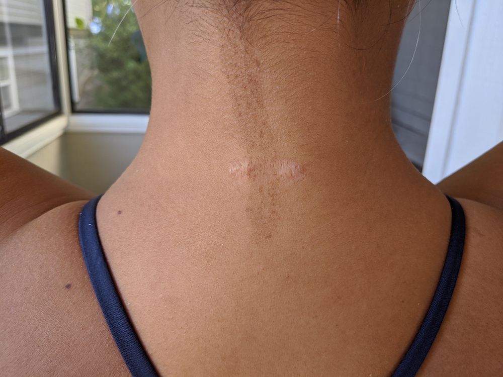 keloid scar steroid treatment 4th injection nape of neck scars
